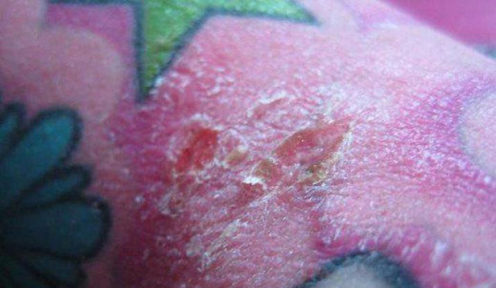 Как определить, что татуировка воспалилась Поднялась температура после татуировки